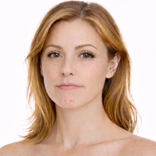 Frau mit langen, welligen Haaren und Fokus auf Behandlungszone „Erdbeerkinn“